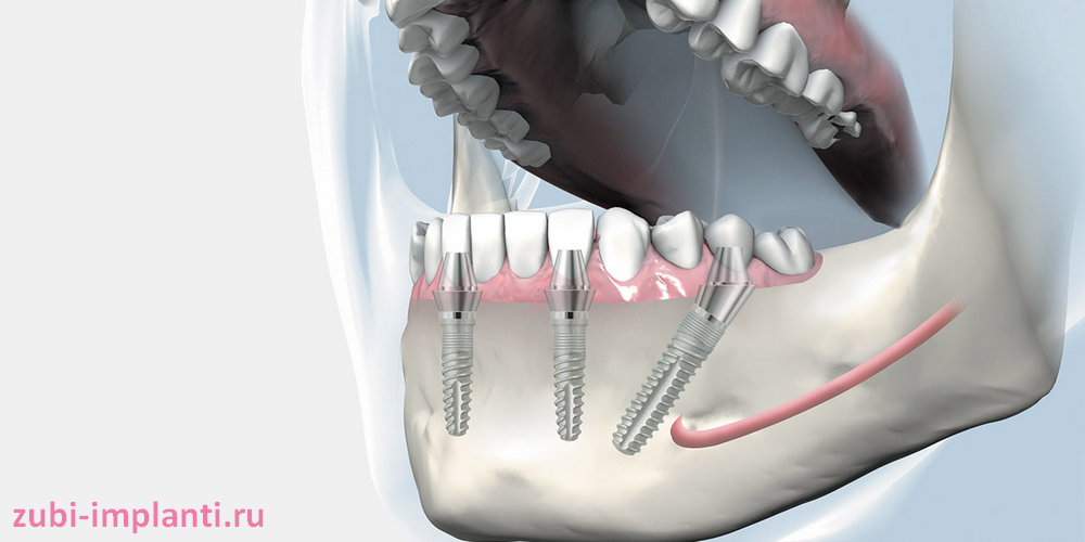 как проходит одномоментная имплантация зубов