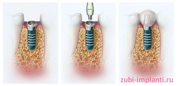 одномоментный способ установки зубного импланта
