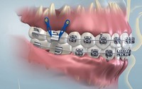 ортодонтические мини-имплантаты