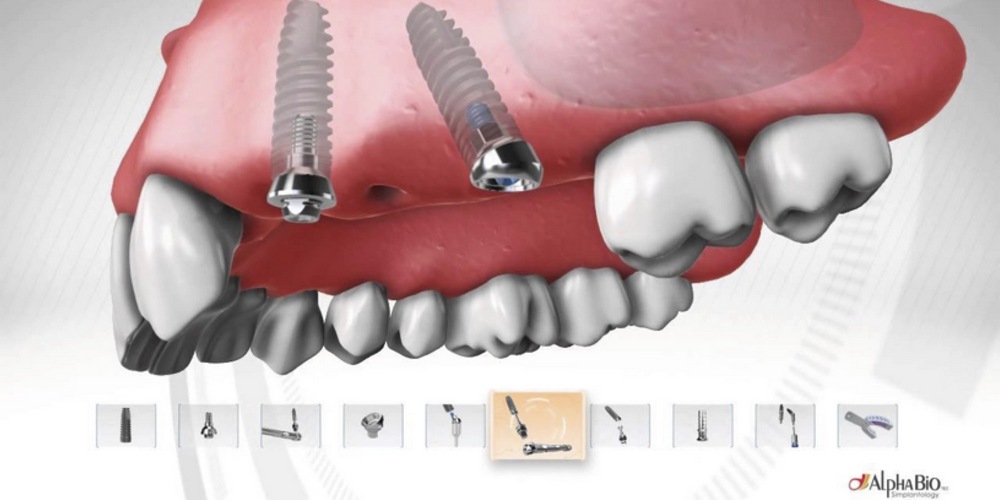 особенности зубных имплантов альфа био