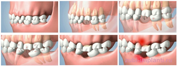 последствия отсутсвия зубов