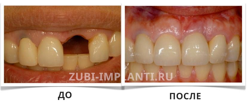 имплантация переднего зуба до и после
