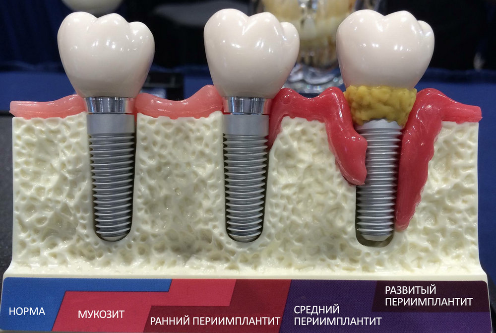 этапы развития периимплантита