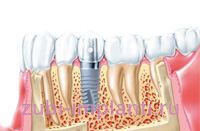 история имплантации зубов