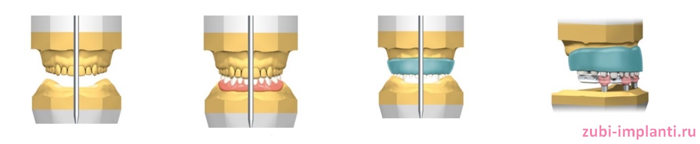 подготовка к имплантации с помощью артикулятора