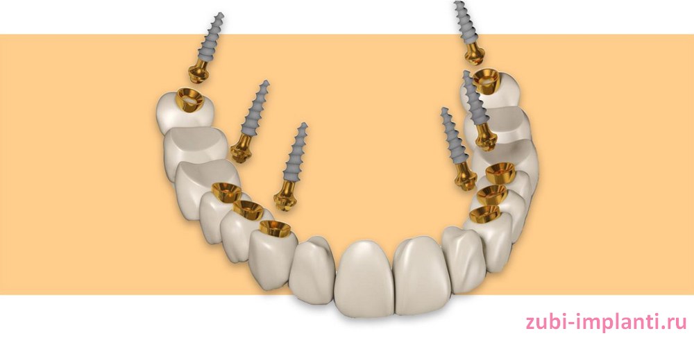 Преимущества компрессионной имплантации зубов