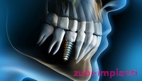 приживление зубного импланта