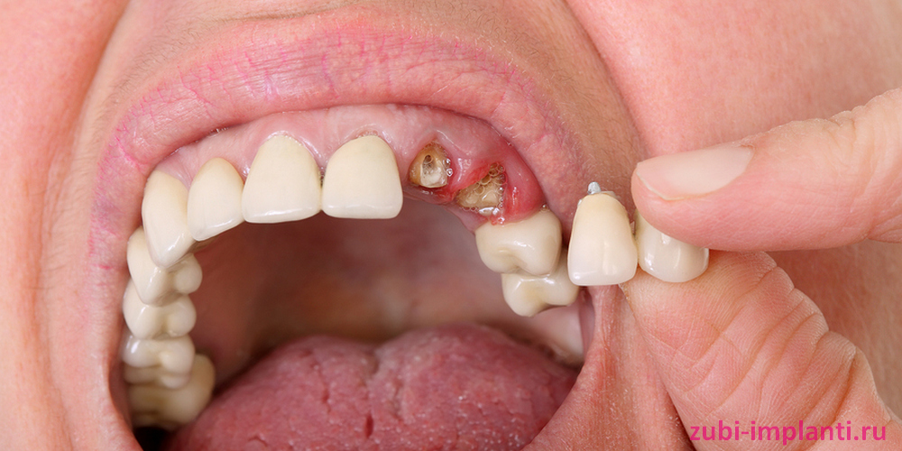 проблема с зубным мостом