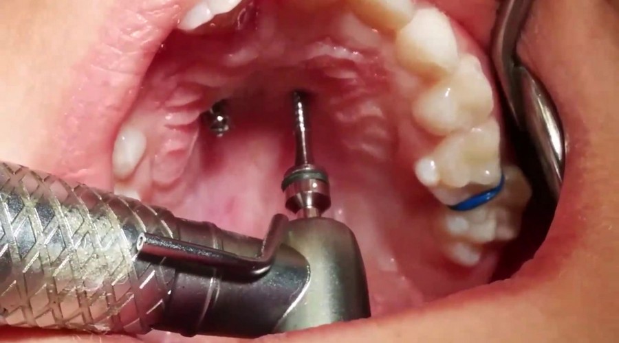 этапы установки ортодонтических мини имплантов