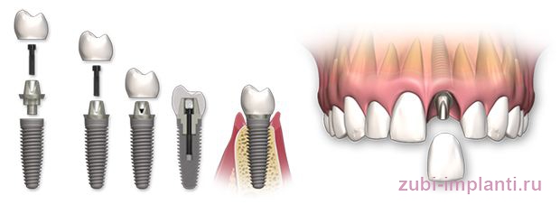 установка зубной коронки на имплантат