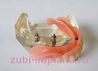 зубные протезы на имплантах