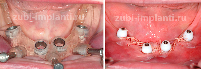 процесс устновки зубных имплантов