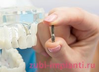 что делать если шатается зубной имплант