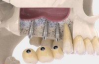 синус-лифтинг и имплантация зубов