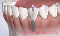 методы установки зубных имплантов