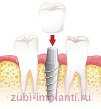 установка корневидного зубного импланта