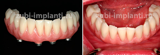 фото протеза на имплантах во рту пациента