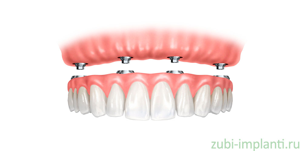 Протезирование на зубных имплантах