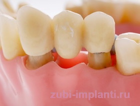 мостовидное протезирование передних зубов