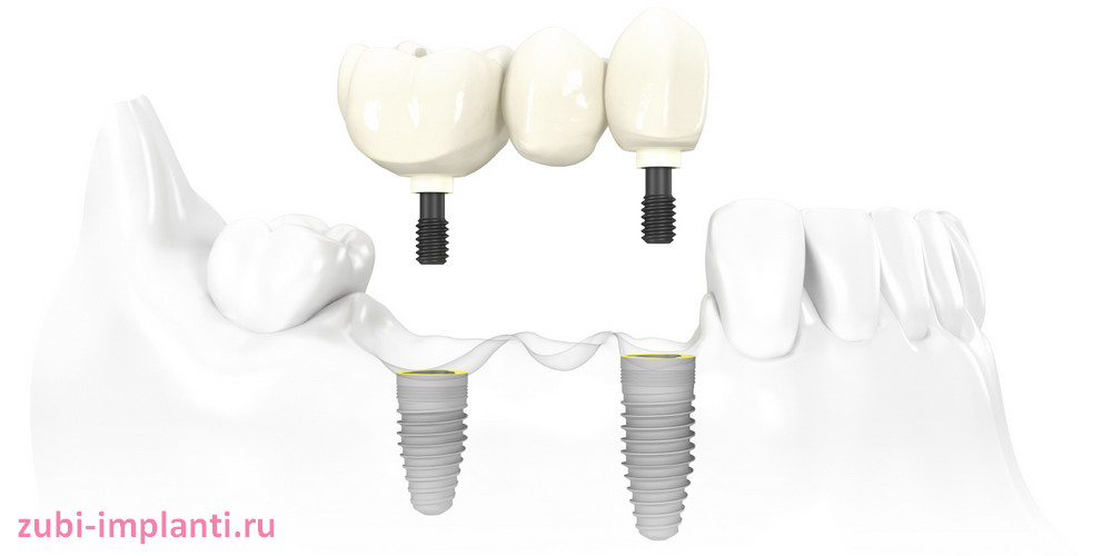 Зубной мост на имплантах более надежен чем обычный
