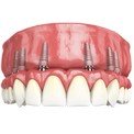 Протезирование зубов All-on-6