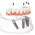 Полная имплантация и протезирование зубного ряда