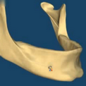 Атрофия костной ткани на всей челюсти