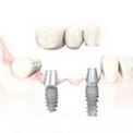 Имплантация или зубной мост