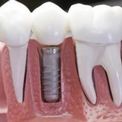 Что будет если не восстанавливать утерянные зубы?