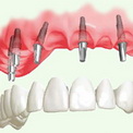 имплантация зубов при пародонтозе