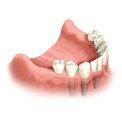 Имплантация -  альтернатива зубному мосту