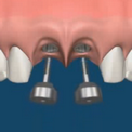 Имплантация для восстановления нескольких зубов