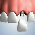 имплантация передних зубов