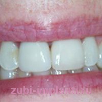 Восстановление переднего зуба с помощью классической имплантации