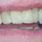 Протезирование передних зубов на имплантах