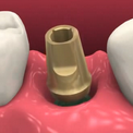 Восстановление зубов имплантами BioHorizons