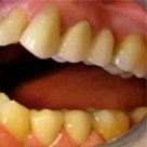 Восстановление зуба с помощью классической имплантации