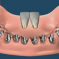 Имплантация всей челюсти (Не съемная конструкция)