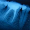 Ортопантомограмма при имплантации зубов