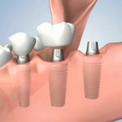 Отсутствие нескольких зубов - лечение
