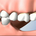 Отсутствие нескольких зубов - негативные последствия