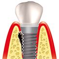 отторжение зубного имплантата