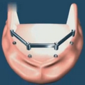 Имплантация для опоры съемных протезов при полном отсутствии зубов