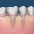Сохранение альвеолярного гребня и кости после удаления зубов