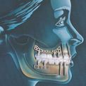 Субпериостальные зубные импланты