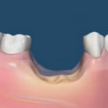Уменьшение кости после удаления зуба