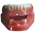 Внутрислизистые зубные импланты