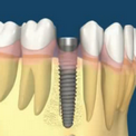 Восстановление разрушенного зуба имплантом одномоментно