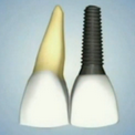 Введение в имплантацию зубов